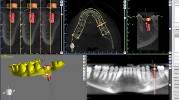 Guide Tube Collision Repair