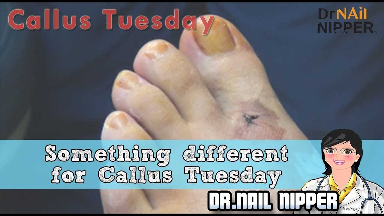 What is Under the Gauze? Something Different for Callus Tuesday 20