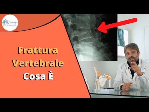 Video: Osteocondrosi Polisegmentale Della Colonna Vertebrale: Sintomi, Trattamento, Cause