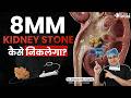 8mm kidney Stone? सर्जरी जरूरी है या नहीं? 4 Treatment Options Explained | Dr. Deepanshu Gupta