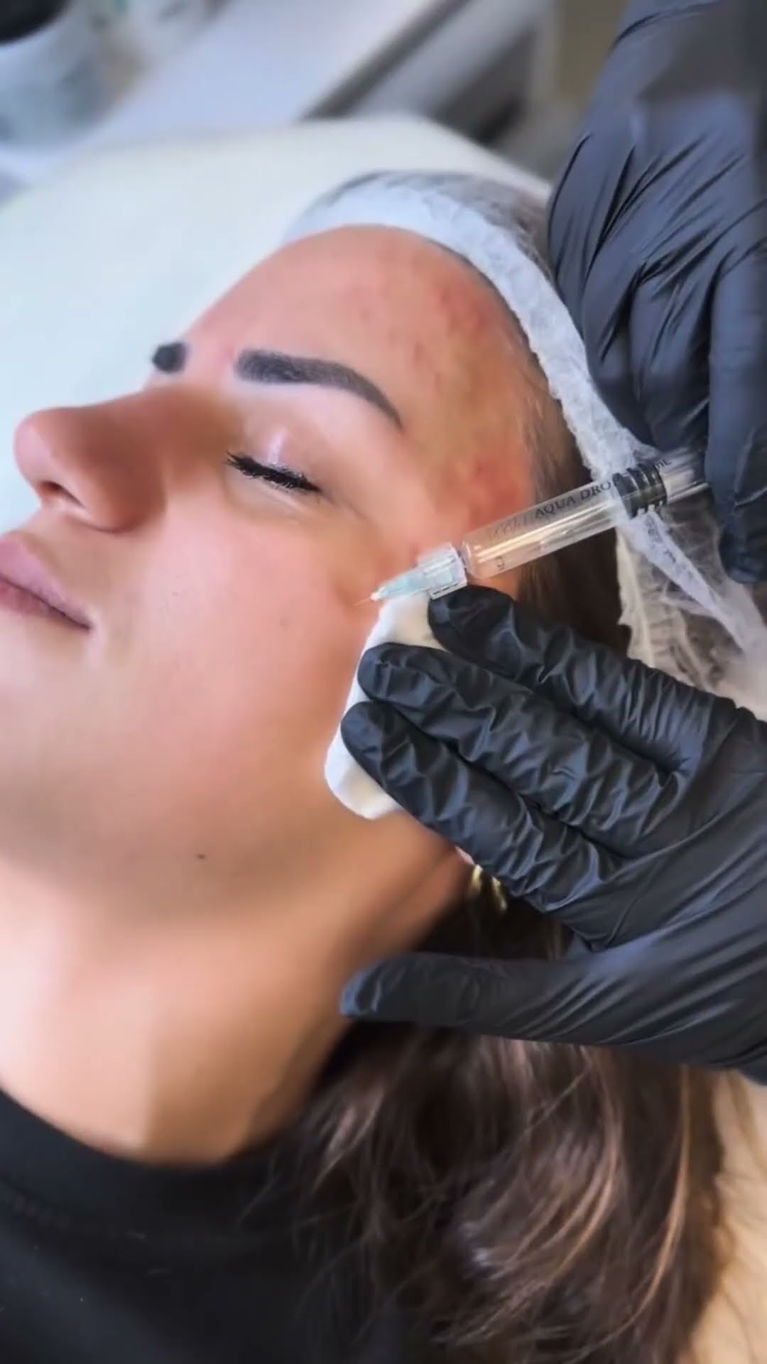 Sappir Aqua Drop — biorevitalizasiya