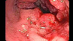 Rectal Cancer and Internal Hemorrhoids