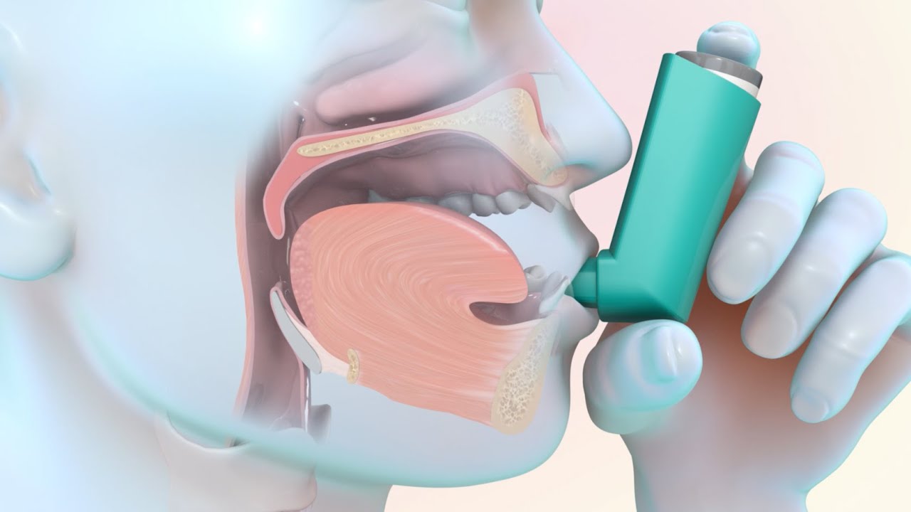 How to Use a Metered Dose Inhaler with a Spacer