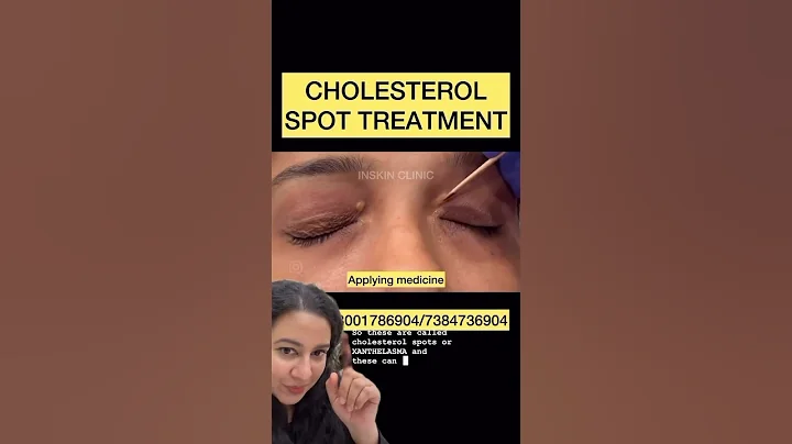 Xanthelasma treatment. #shorts #dermshorts