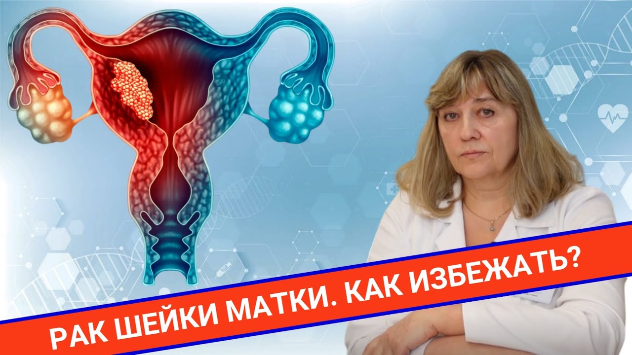 РАК ШЕЙКИ МАТКИ: чем опасен? - YouTube