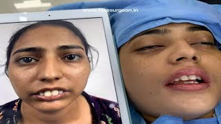 FACEMAKEOVER Surgery with Orthognathic, Jaw Osteotomies, Nosejob