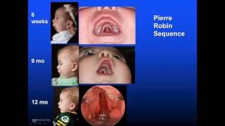 Mount Sinai Dept. of Otolaryngology Cleft Lip & Palate State of the Art & Science 4-16