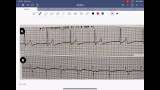 EKG series: Part#3 Escape Pacemakers