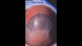 Slit Making in Hair Transplant || Hair Transplantation Procedure Live || Hairfree & Hairgrow Clinic