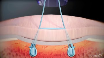 Knotless FiberTak® Soft Anchor: Interconnected Remplissage Technique