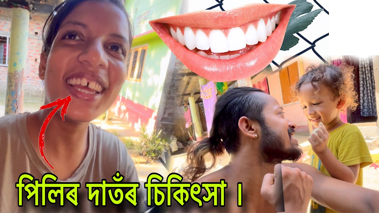 পিলিৰ দাতঁ চিকিৎসা কৰাম বুলি ভাবিছো । 