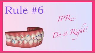 IPR , do it right!  - Invisalign Mini Course 7 of 8 part I