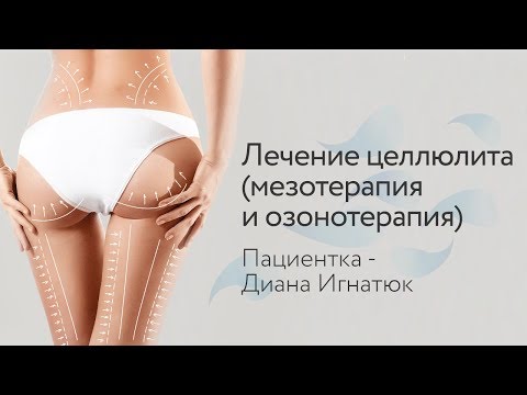 Лечение целлюлита (мезотерапия и озонотерапия). Пациентка - Диана Игнатюк
