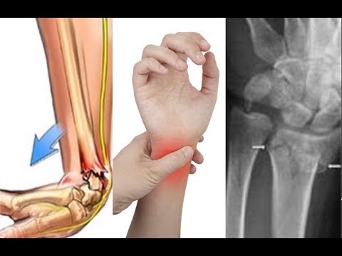 Video: Pitman kolu kırılırsa ne olur?
