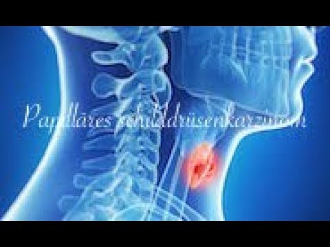 Video: Schilddrüsenmetastasen - Papillärer Schilddrüsenkrebs