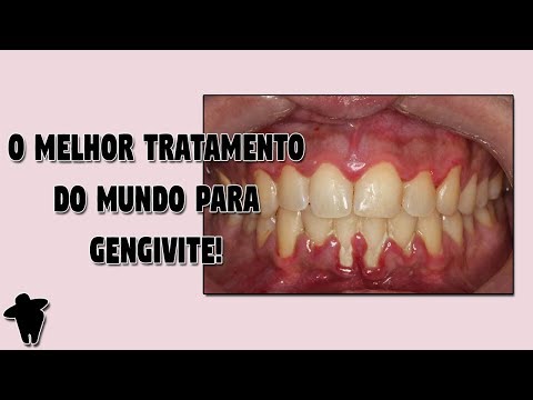 Vídeo: Gengivas Vermelhas Em Gatos (incluindo Gengivite): Sintomas, Fotos De Vermelhidão Ao Redor Dos Dentes, Diagnóstico E Tratamento Em Casa