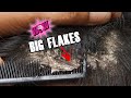 Really Big Dandruff Flakes Removal Front Side!! Dandruff Scratching Itchy Scalp