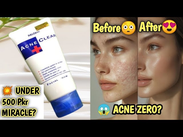 mistine glutathione face wash review Shadiyon Mein Makeup, Lekin Acne Zero 😍 Mite bite