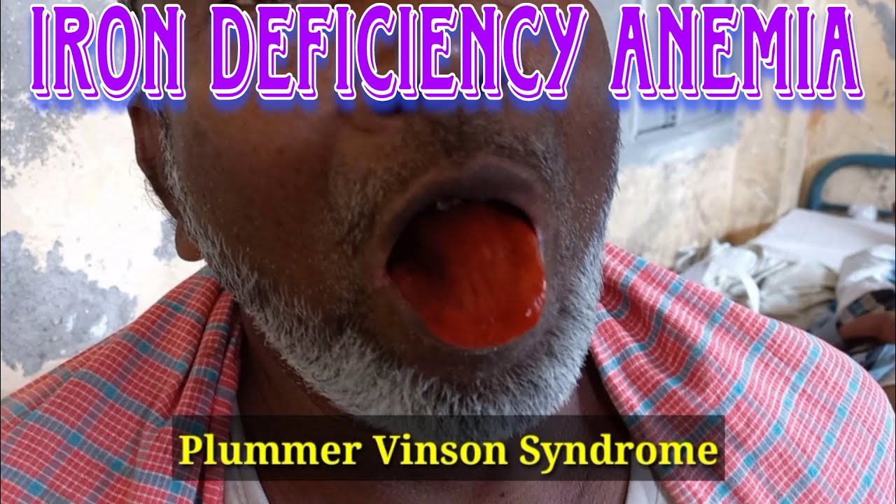 Iron deficiency anemia koilonychia Plummer Vinson Syndrome 