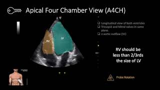 Right Heart Strain on POCUS | Signs of PE, Pulm HTN & RV Overload