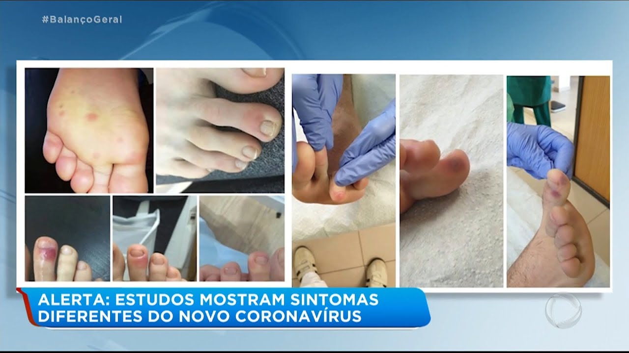 Estudos mostram que pessoas com coronavírus podem ter sintomas diferentes