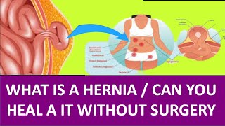 WHAT IS A HERNIA I CAN YOU HEAL  IT WITHOUT SURGERY