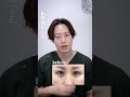 他院修正▶脱脂+脂肪注入したのに失敗した事例
