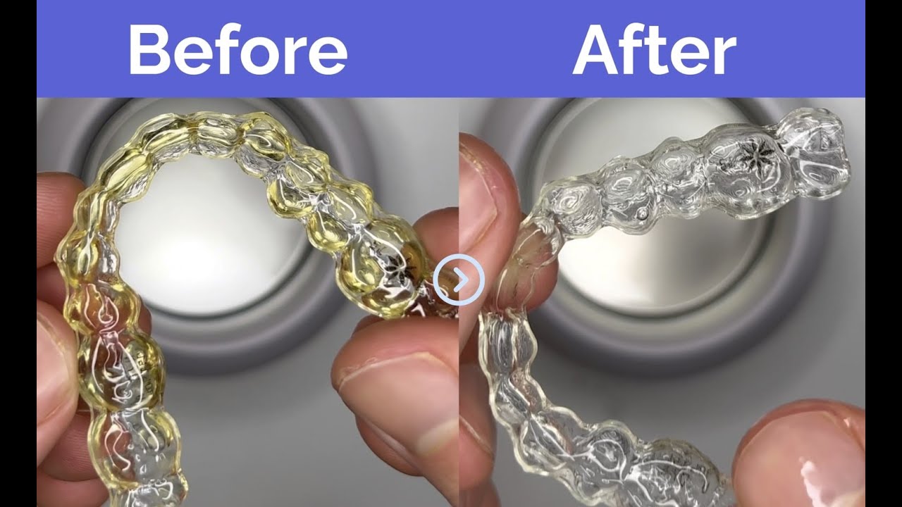 How to remove any stain from your retainer 
