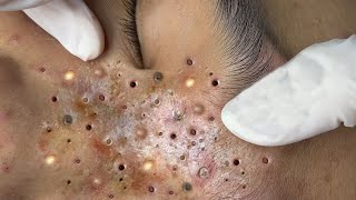 Relax Every Day With Treatment Satisfying blackhead relaxing acne, pimple, cyst by FISHING VIDEO 66 views 1 year ago 5 minutes, 6 seconds
