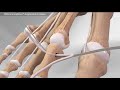 EDB InternalBrace™ Augmentation Repair