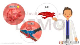 [시연용] b0011adko [대한위대장내시경학회][축약판]대장내시경검사 안내