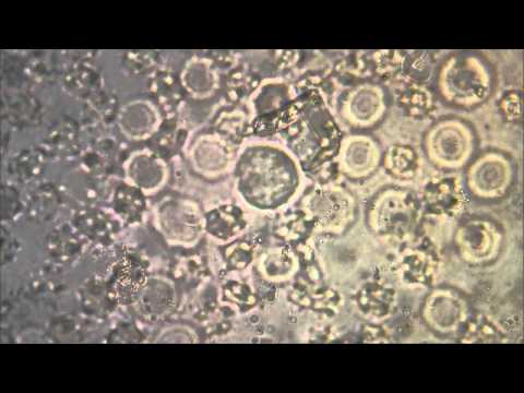 Exame microscopico do sedimento leucocitos