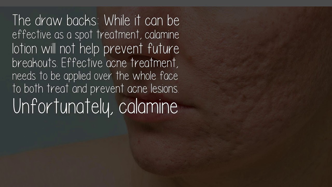 How Effective Is Calamine Lotion On Acne?