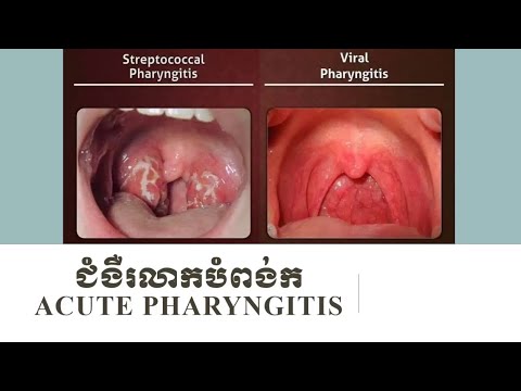 Acute pharyngitis - រលាកបំពង់ក by Dr. Sothea