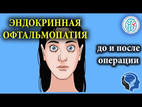 Эндокринная офтальмопатия до и после операции