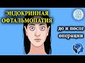 Эндокринная офтальмопатия до и после операции