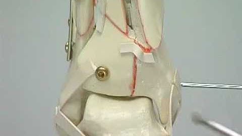 Tibial pilon fracture LCP distal tibial plate By Adiy Ortho Point