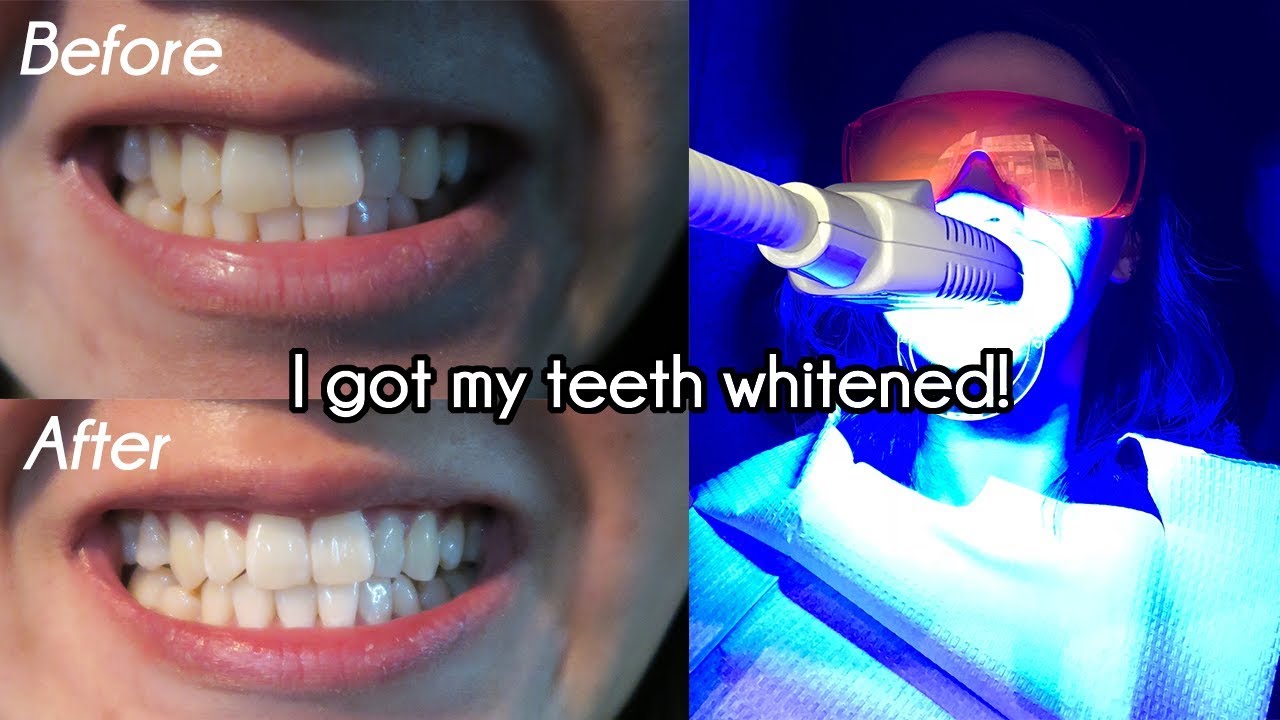 Teeth Whitening Without Sensitivity Mint Smile Bar You Teeth Whitening Without Sensitivity Mint Smile Bar