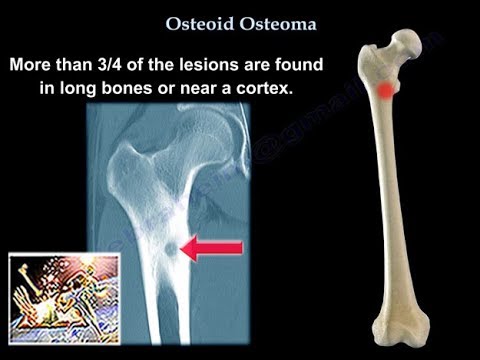 Osteoid Osteoma - Таны мэдэх ёстой бүх зүйл - Доктор Набил Эбрахейм