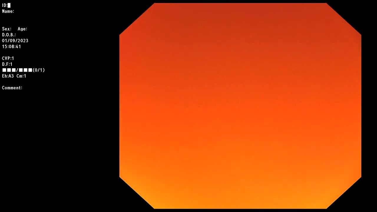 ERCP ; Needle knife precut access to bile duct.