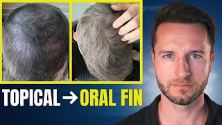 I Switched From Topical to Oral Finasteride Twice. Was it Worth It?