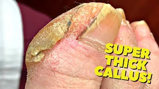 THICK Cracked Callus Trimming! (Satisfying)