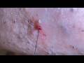 Plucking facial hair & ingrown hair 1444 頬髭抜き(埋没毛あり)