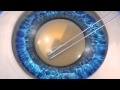 LENSAR Laser Cataract Surgery Parkhurst NuVision San Antonio