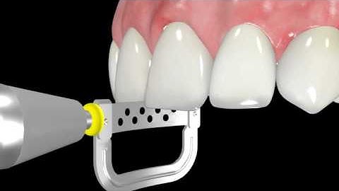 oscident IPR instruction "Strips" manually use