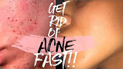 How to Get Rid of Acne & Acne Scars FAST!!