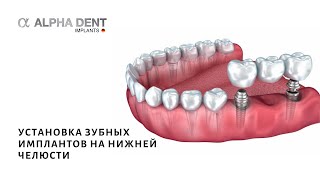 Установка зубных имплантов на нижней челюсти(Дентальная имплантация на нижней челюсти. Костная пластика с использованием мембраны. Подписывайтесь..., 2014-07-10T08:45:17.000Z)