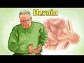 Hernia Causes, Symptoms and Treatment 