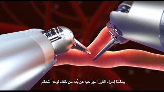 Totally Endoscopic Robotic Coronary Bypass (TECAB)
