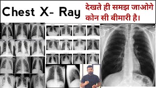 Chest X Ray | X Ray | X Ray Reading | Pneumonia | Lungs Effusion | X Ray Technician | Doctor | bhms